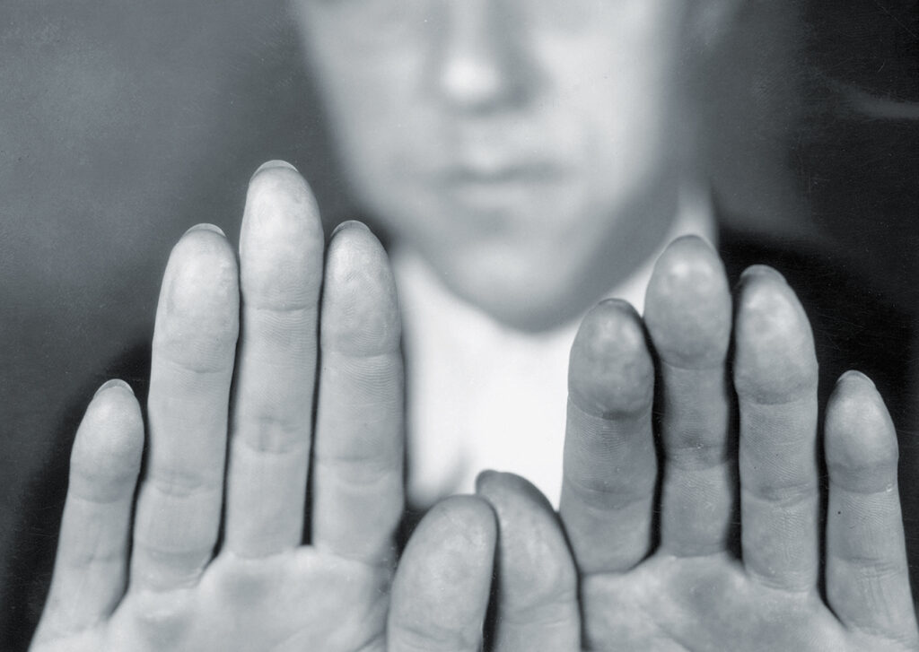 Photo of Alvin Karpis showing that his fingerprints had been removed by underworld physician Joseph Moran.